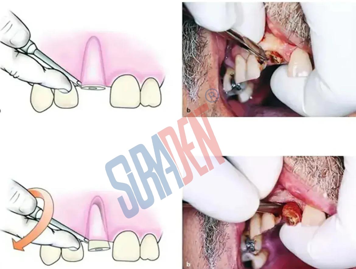 Suryadent Hiedbrink Root Pick Set – Left, Right & Straight - Image 2