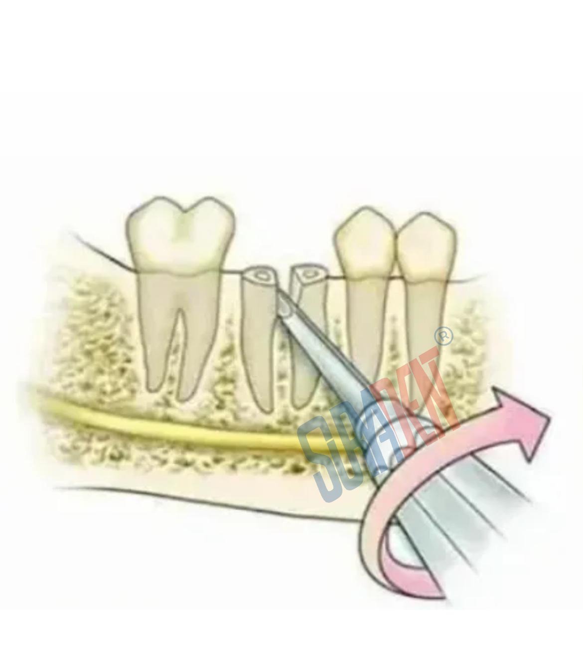 Suryadent Hiedbrink Root Pick Set – Left, Right & Straight - Image 3